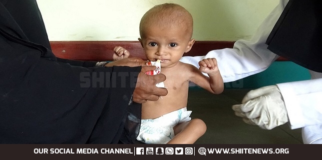 WHO: 75% of Yemen’s children chronically malnourished