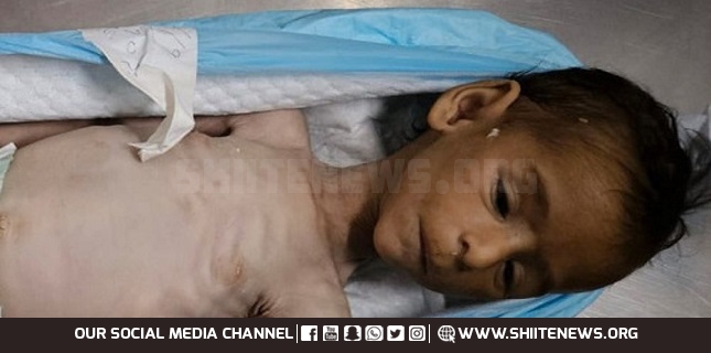 Third Palestinian child succumbs to Israeli-enforced starvation in Gaza in a single day